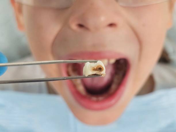 Best Emergency Dental Care for Broken or Chipped Teeth in Greene, IA